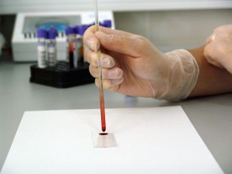 Εξέταση αίματος ανίχνευσε με 83% ακρίβεια τον καρκίνο του παχέος εντέρου - Στη μελέτη συμμετείχαν 7.861 άτομα
