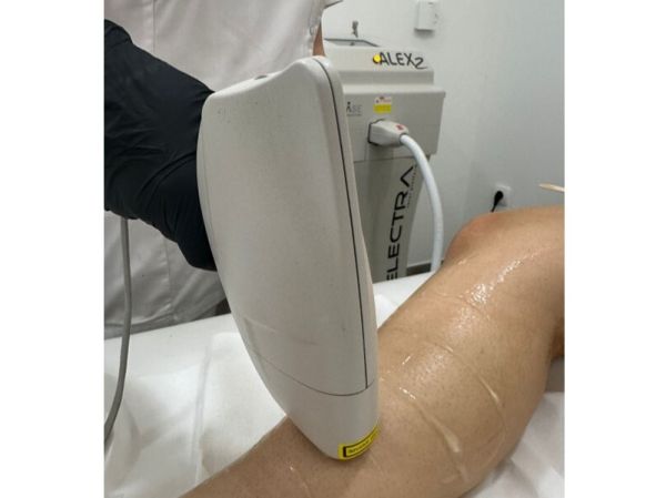 Αποτρίχωση με Laser Αλεξανδρίτη: Μια σύγχρονη και αποτελεσματική λύση