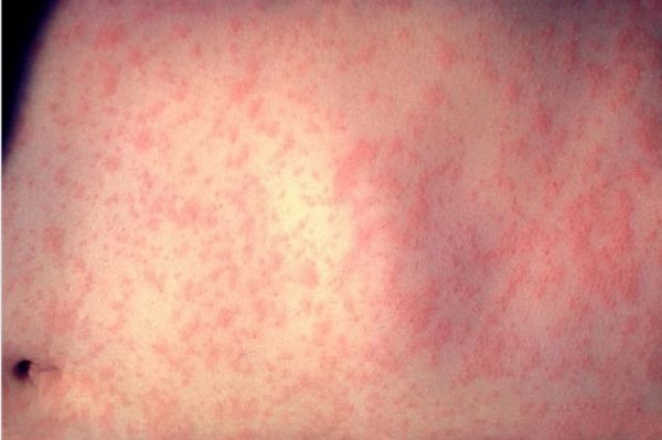 Αύξηση των περιστατικών ιλαράς σε παγκόσμιο επίπεδο