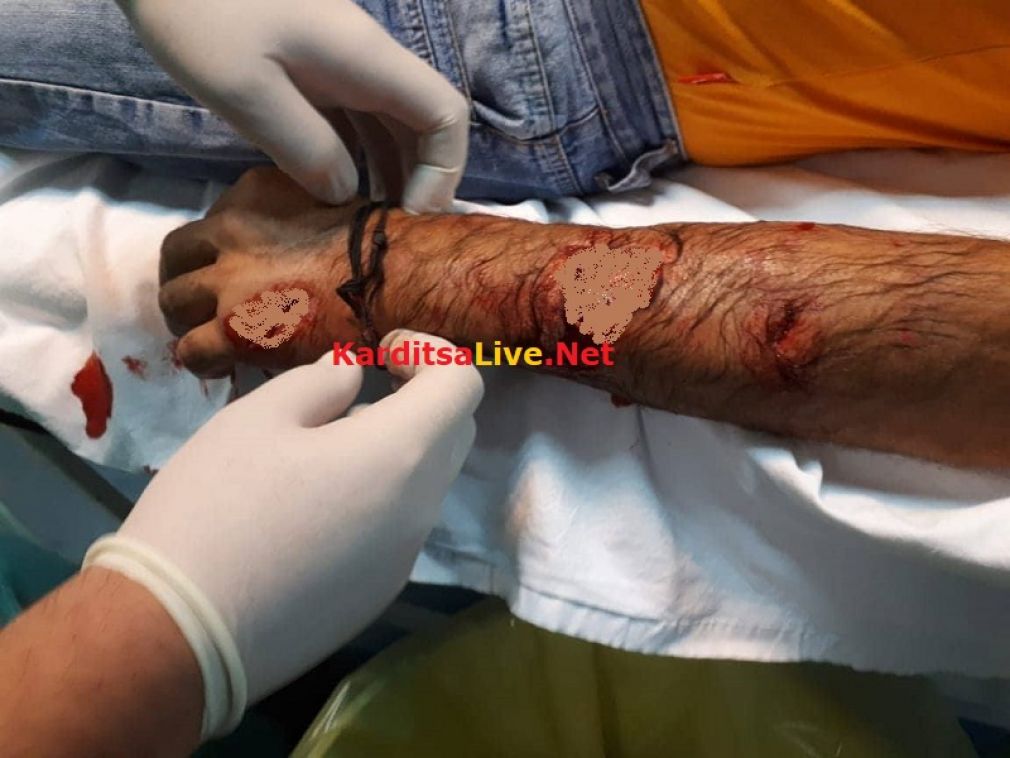 Με σοβαρά τραύματα στο χέρι κάτοικος του Μουζακίου από επίθεση αδέσποτου σκύλου