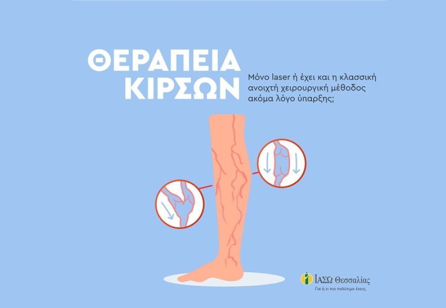 ΙΑΣΩ Θεσσαλίας: Θεραπεία κιρσών; Laser ή κλασσική ανοικτή χειρουργική μέθοδος;