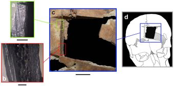 Τετράγωνη τρύπα σε κρανίο &quot;δείχνει&quot; προσπάθειες για χειρουργική εγκεφάλου πριν 3.500 χρόνια στο Ισραήλ!