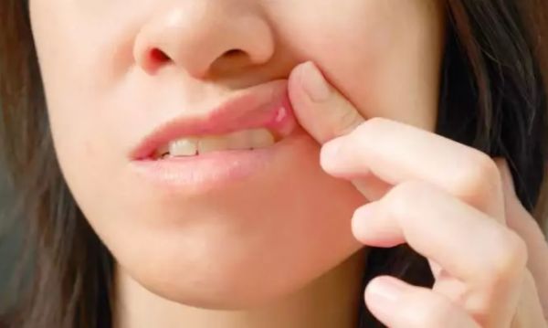 Τι να κάνετε για τις άφθες στο στόμα – Γιατί εμφανίζονται εξαρχής