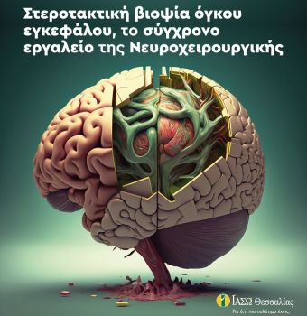 ΙΑΣΩ Θεσσαλίας: Στεροτακτική βιοψία όγκου εγκεφάλου, το σύγχρονο εργαλείο της Νευροχειρουργικής