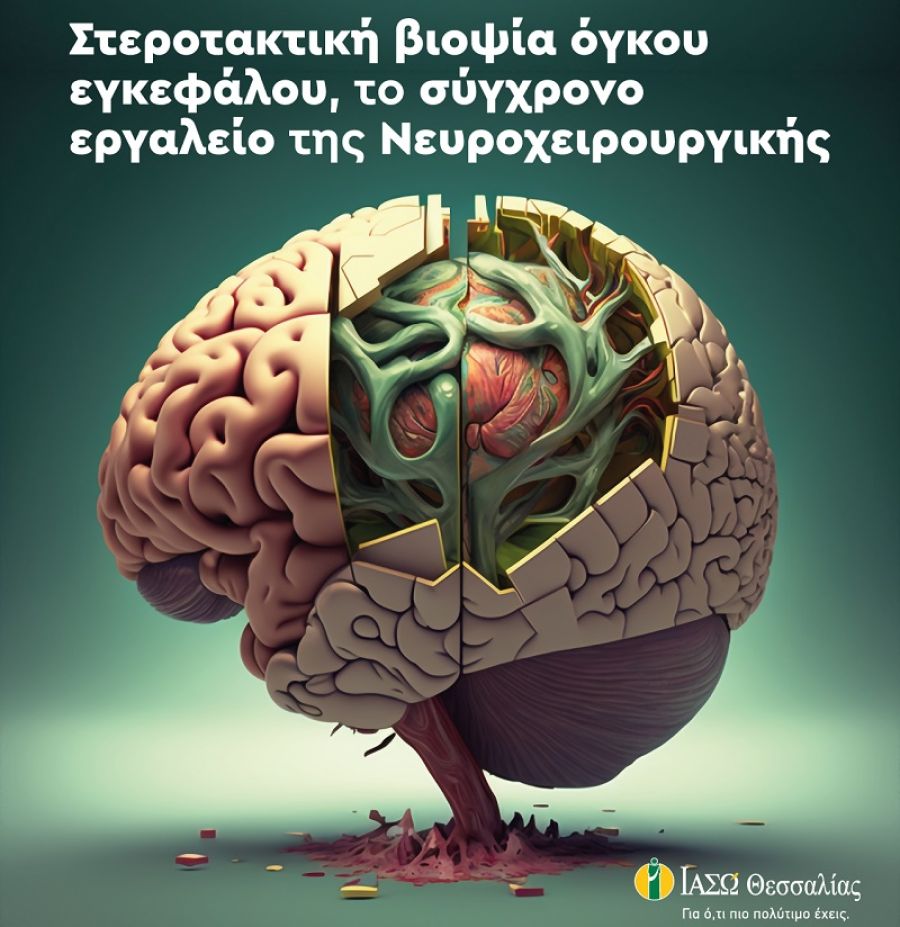 ΙΑΣΩ Θεσσαλίας: Στεροτακτική βιοψία όγκου εγκεφάλου, το σύγχρονο εργαλείο της Νευροχειρουργικής