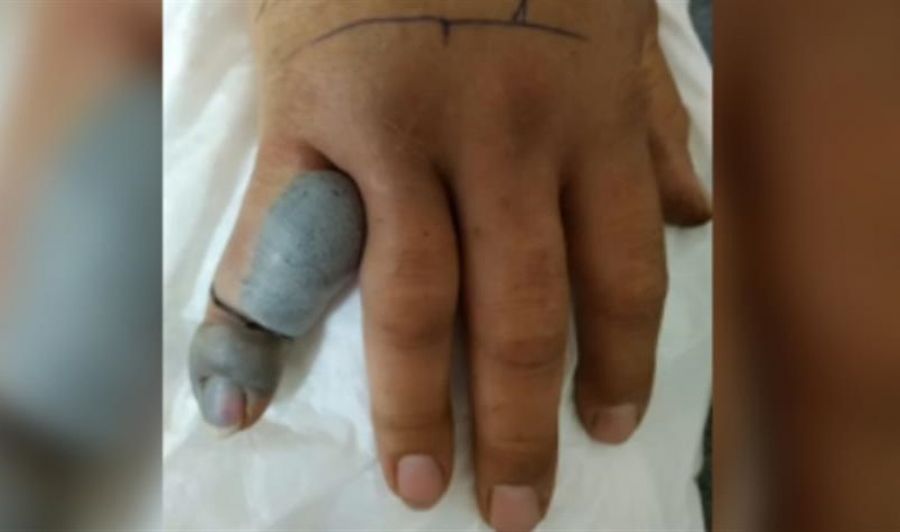 Γόννοι Λάρισας: Του δάγκωσε οχιά το χέρι - Εξιτήριο από το νοσοκομείο μετά από 8 ημέρες(+Βίντεο)